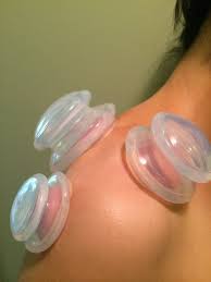 Cupping terapija - rame
