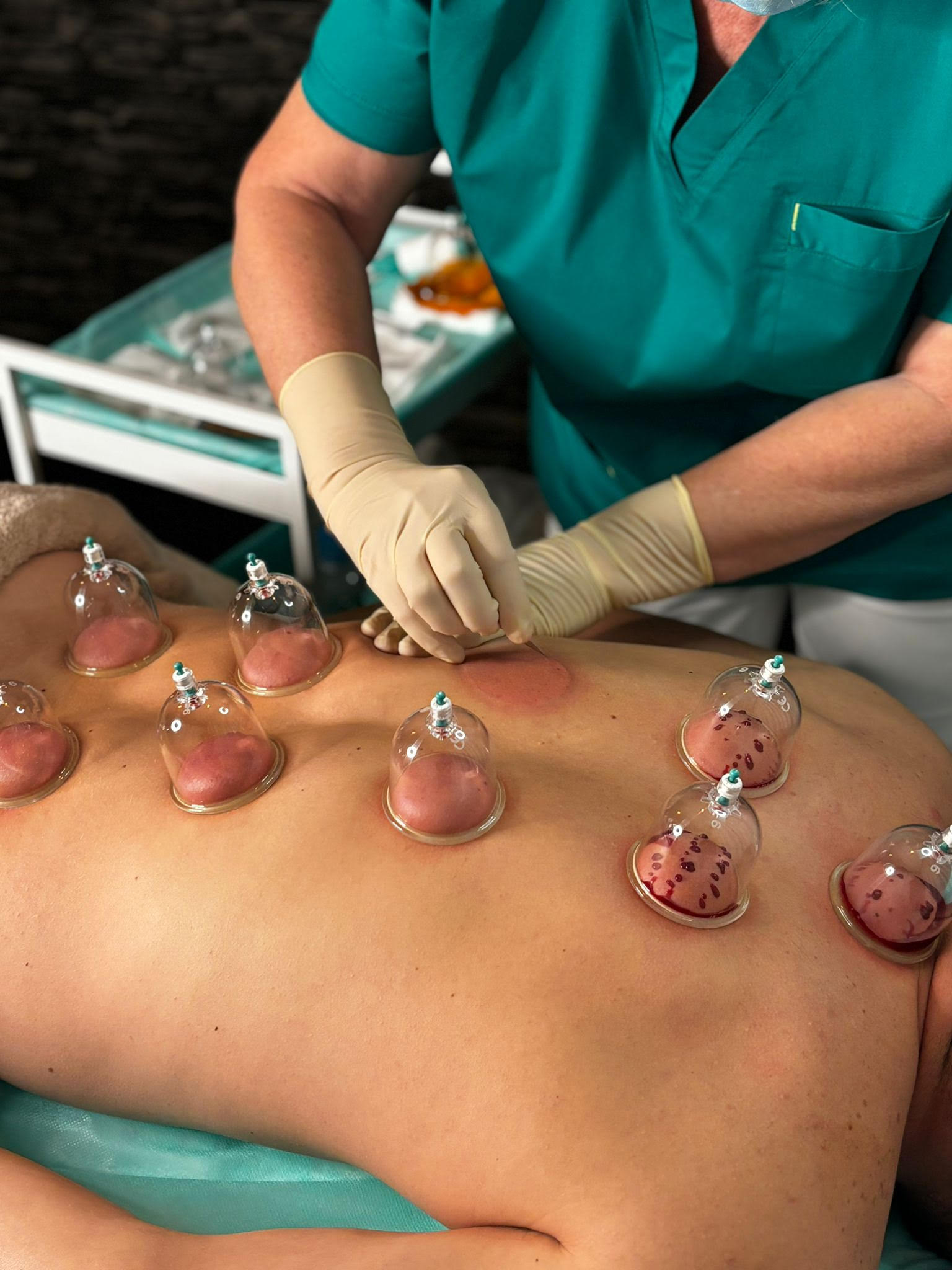 hijama1